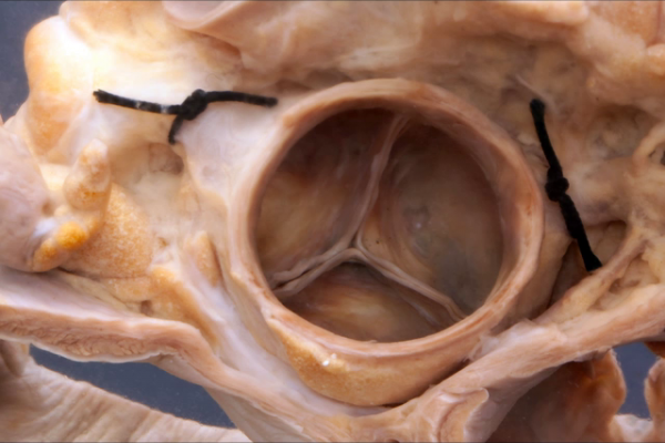 Aortic Stenosis