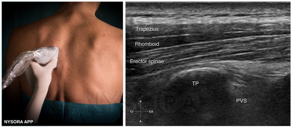 Erector Spinae Plane Block