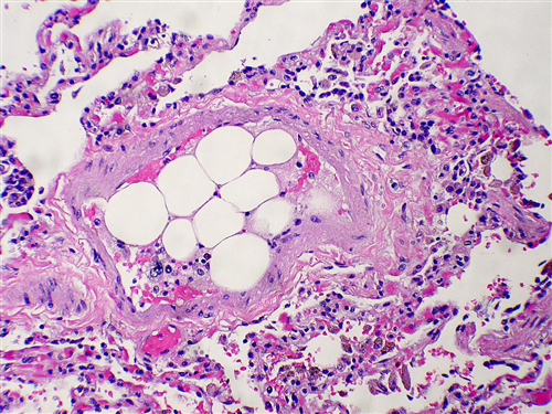 Fat Embolism