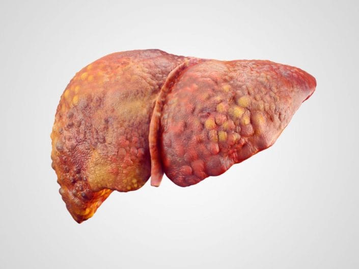 Liver disease