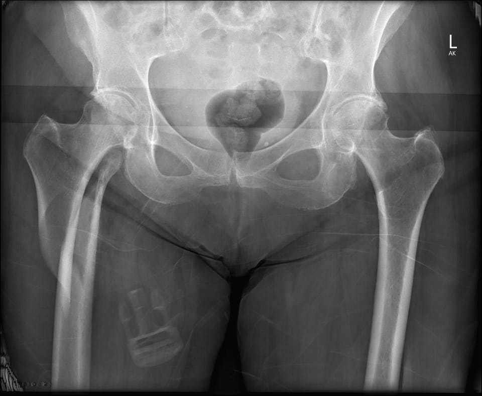 Hip Fractures