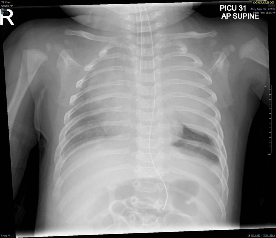 Paediatric Mediastinal Mass